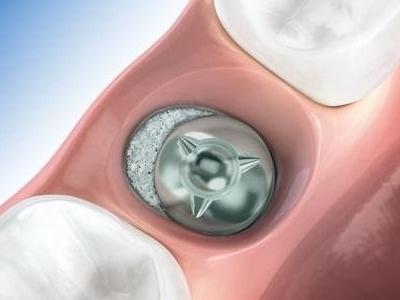 augmentacja-wokol-implantu-150x150